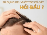 Sự thật về việc sử dụng gel vuốt tóc: Có gây hại và gây hói tóc không?